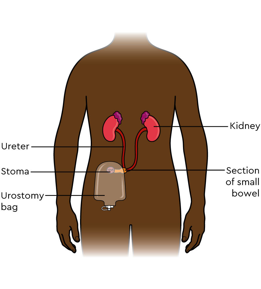 ostomy